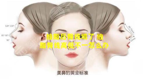 抽脂后臀线塌了 抽脂臀线高低不一怎么办